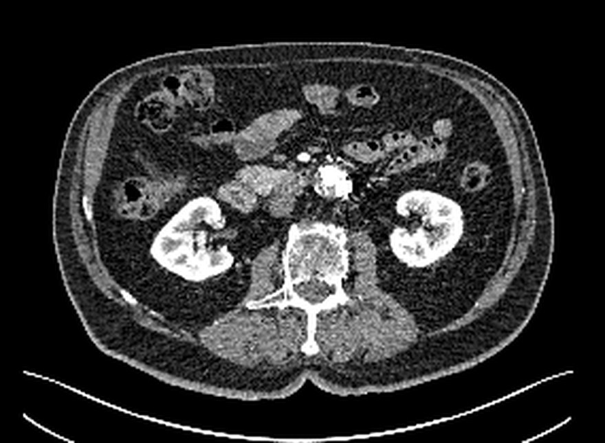 The input to the captioning example: an axial CT slice through the mid-abdomen showing both kidneys, the aorta, the vertebral body and gas-filled bowel loops, at soft-tissue window settings.