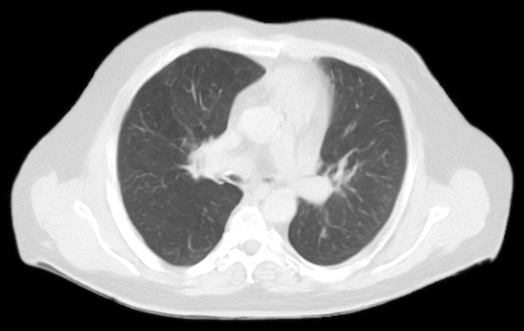 A synthetic thorax CT slice, generated by AI and shown at lung window settings.