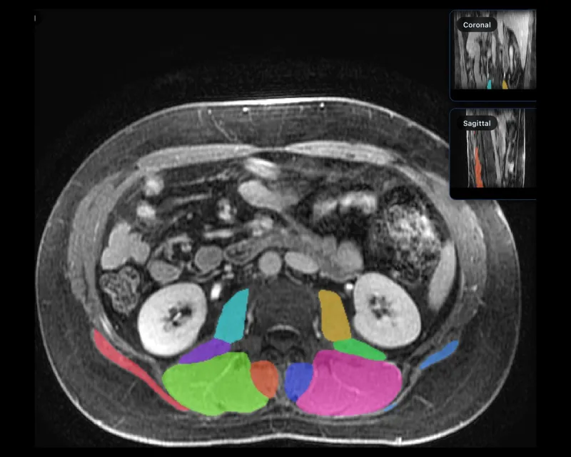 An automatic muscle segmentation on an abdominal MR, every muscle group in its own colour, with coronal and sagittal reference views.