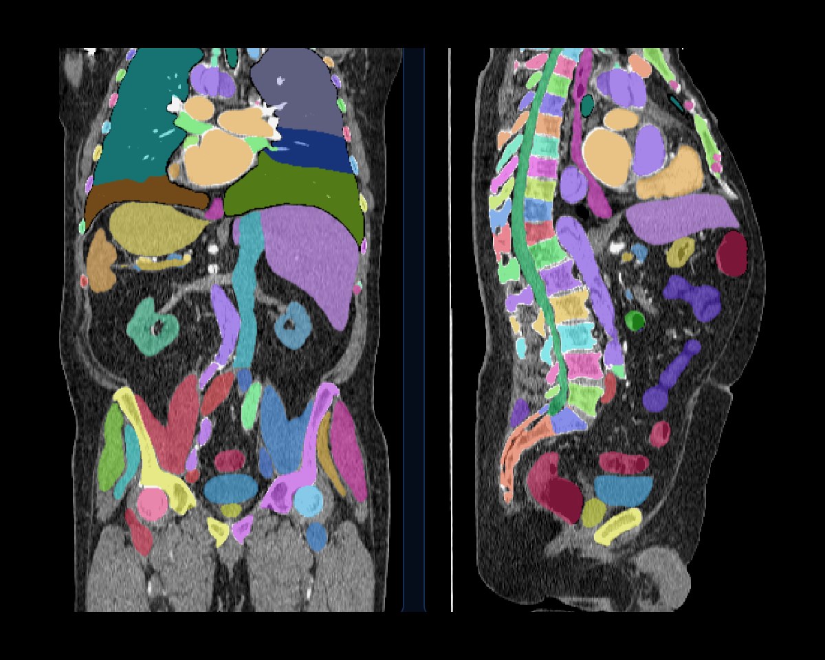 An automatic whole-body CT segmentation shown coronally and sagittally, with organs, vessels and every vertebra labelled in its own colour.