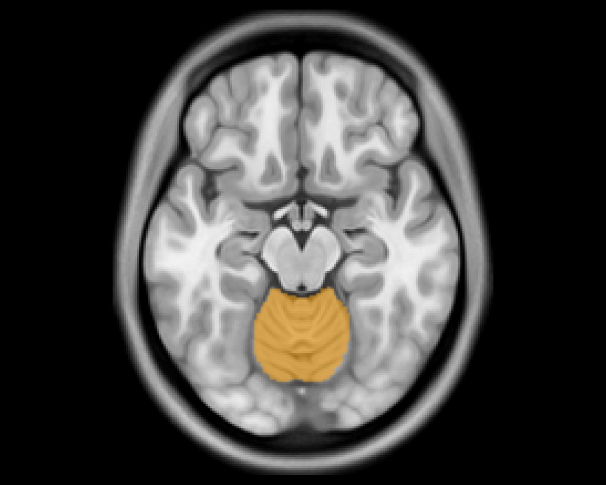 A brain MR with the cerebellum outlined in orange by the click-guided AI.