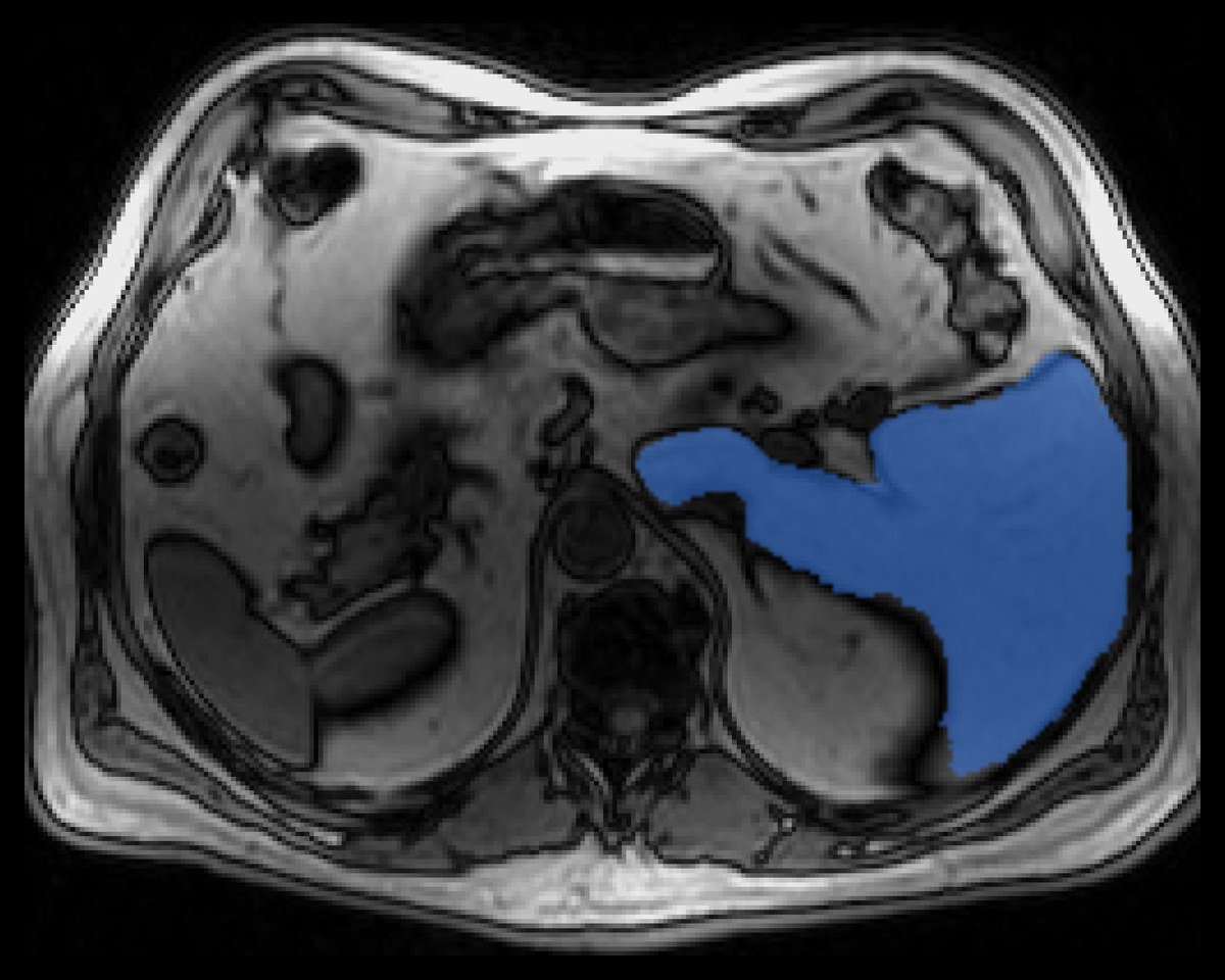 An abdominal MR with the liver filled in blue by the click-guided AI.